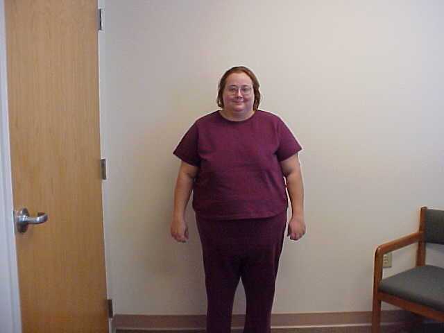 Julie before surgery